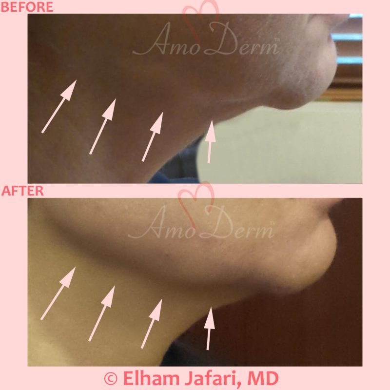 Jawline contouring and restoration with fillers