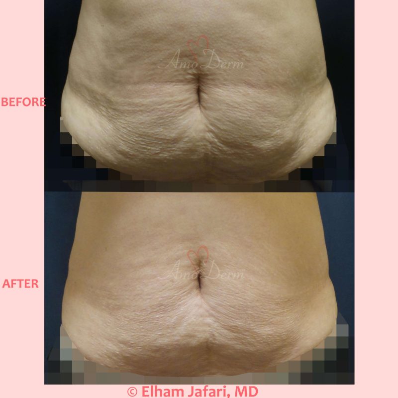 SculpSure Stubborn Fat Reduction