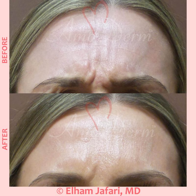Botox injection for treatment of lines and wrinkles in forehead, glabella &amp; frown lines
