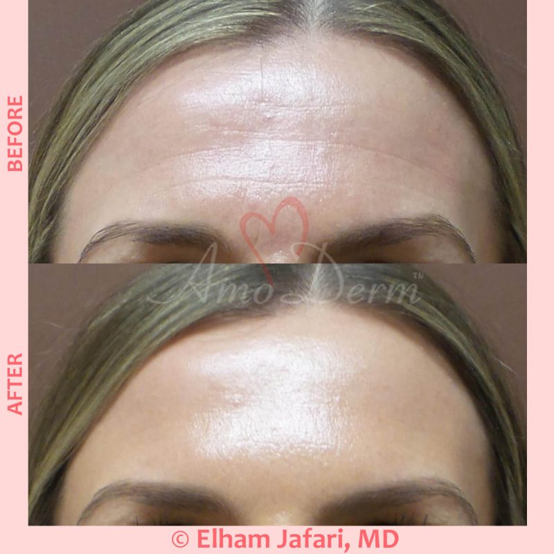 Botox injection for treatment of lines and wrinkles in forehead, glabella &amp; frown lines