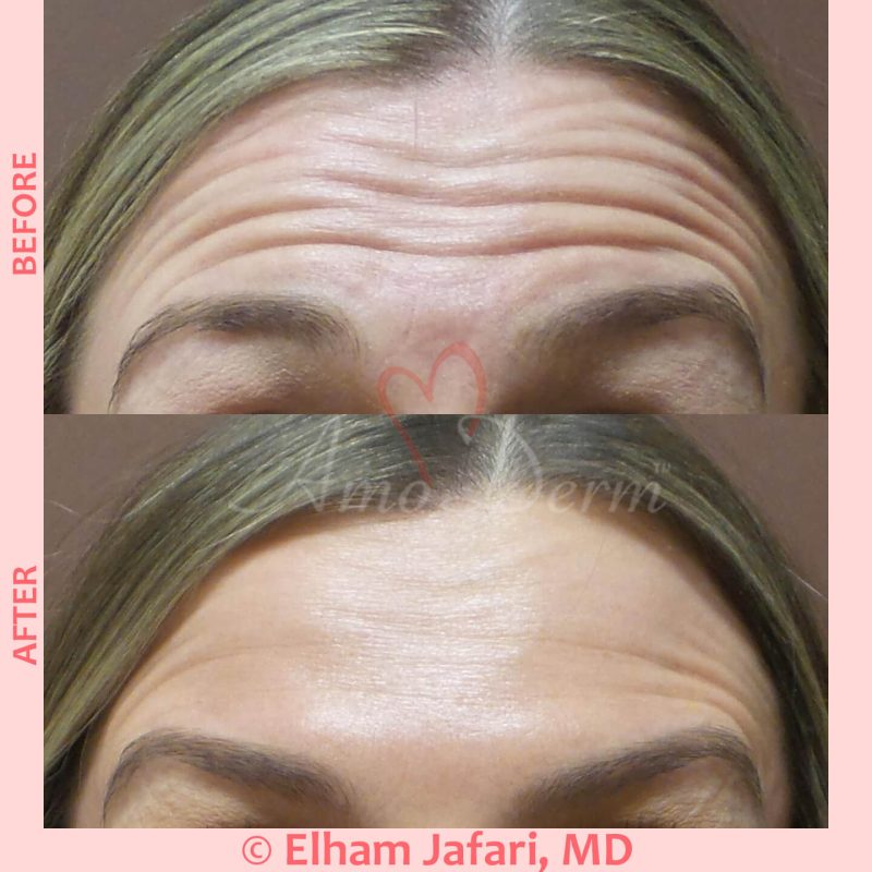 Botox injection for treatment of lines and wrinkles in forehead, glabella &amp; frown lines