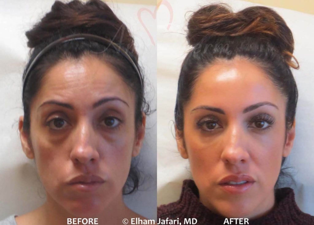 4D Under Eye Lift to treat dark circles under eyes & contour cheeks