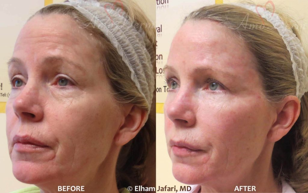4D Under Eye Lift to treat dark circles under eyes & contour cheeks
