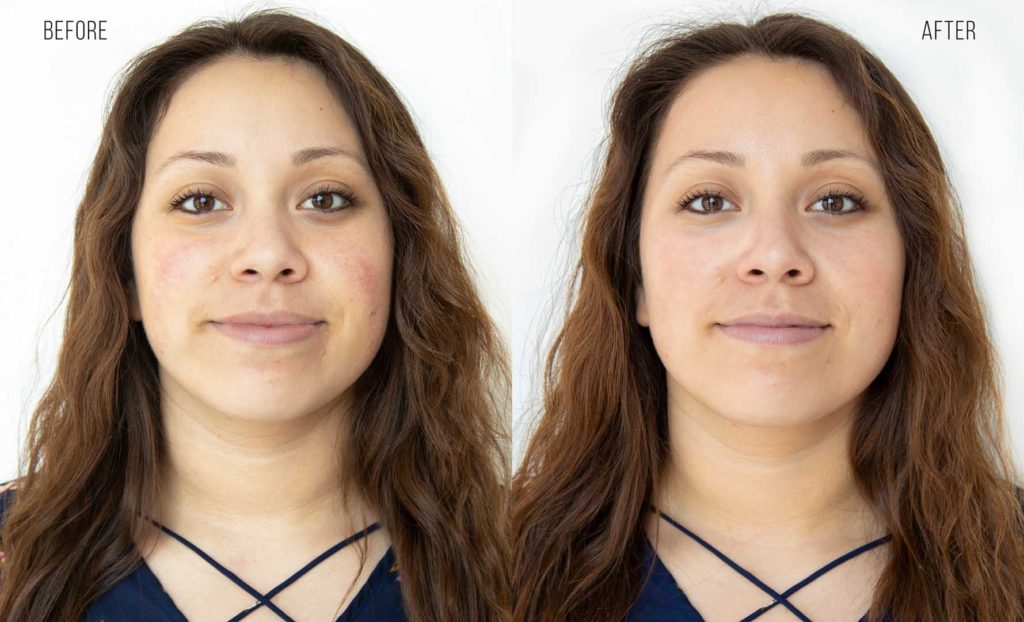 HydraFacial Treatment before-after real picture results