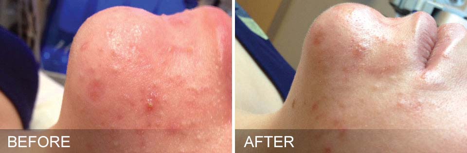 HydraFacial Treatment before-after real picture results