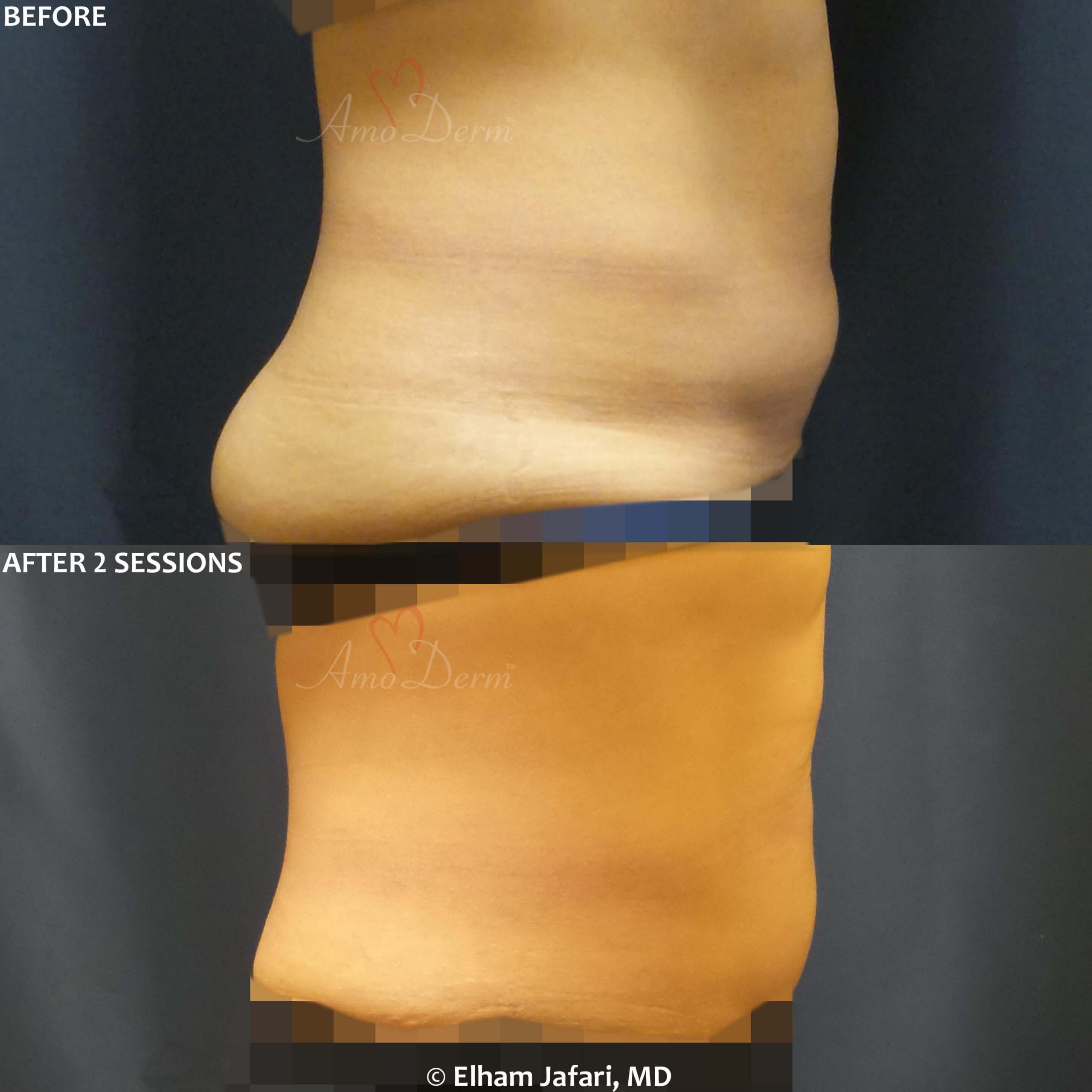 SculpSure NonSurgical Body Contouring Treatments in Irvine