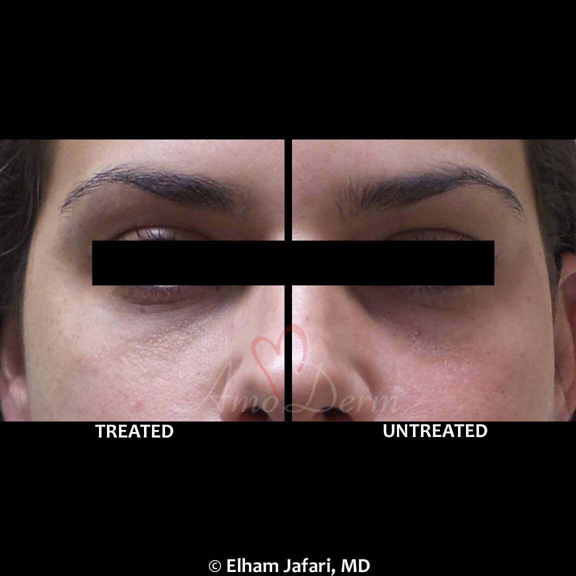 Treat dark circles & bags under eyes using fillers & lasers