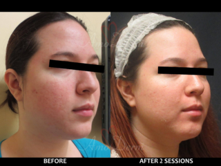 Treatment of acne scars with Fractional CO2 laser skin resurfacing