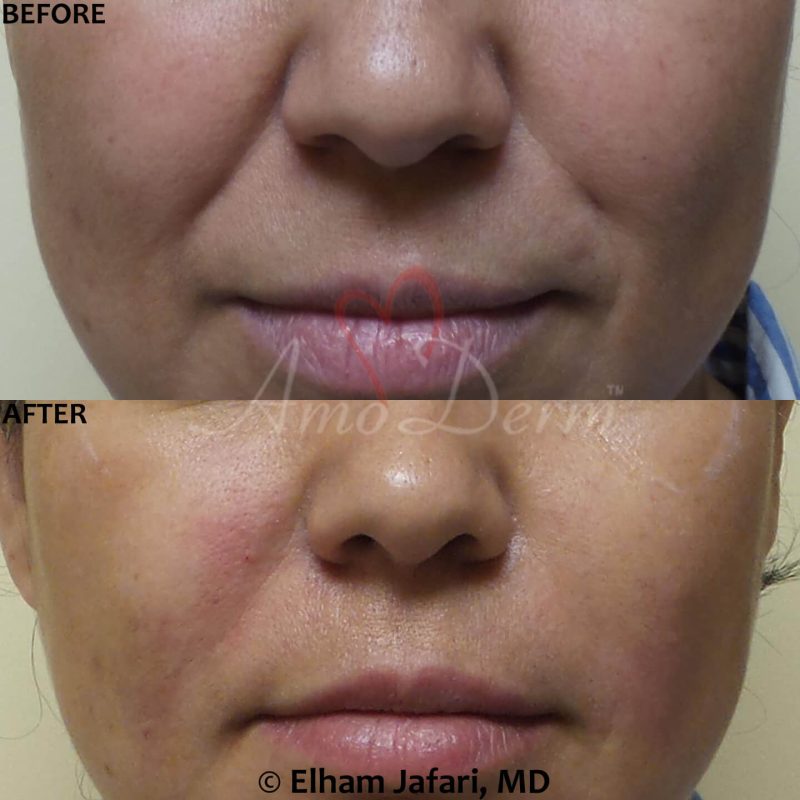Treatment of nasolabial folds