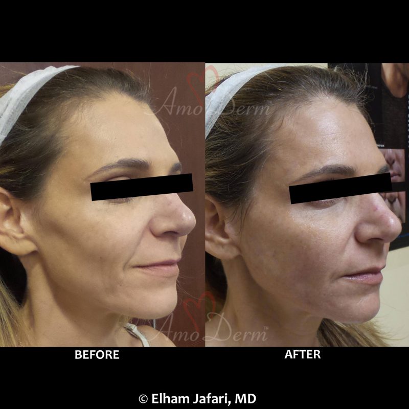 Liquid Facelift with filler to treat hollowness between cheek &amp; jaw, nasolabial folds and marionette lines