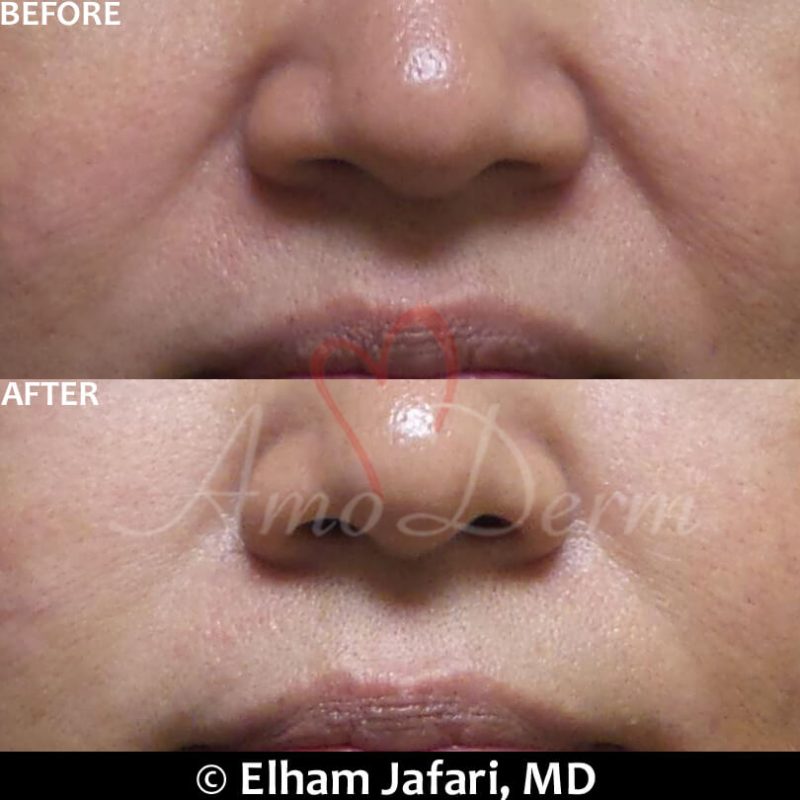 Treatment of nasolabial folds as part of non-surgical facelift