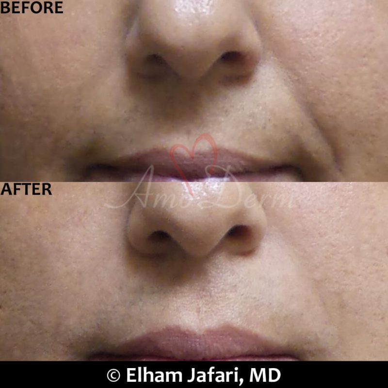 Treatment of nasolabial folds as part of non-surgical facelift