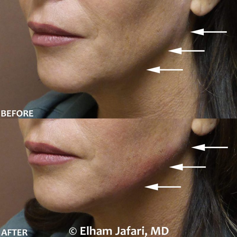 Filler for jawline sculpting and contouring to create a chisled jawline