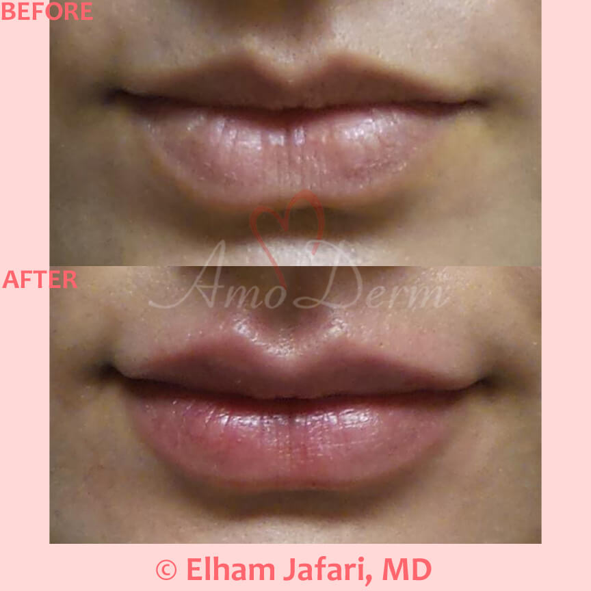 Lip Augmentation Irvine Lip Injections, Lip Fillers, Orange County