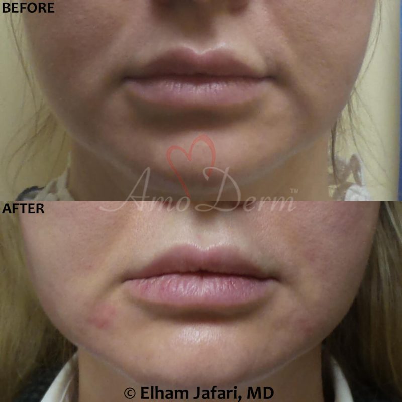 Treatment of nasolabial folds as part of non-surgical facelift