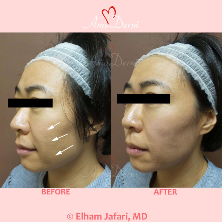 Liquid Facelift with PDO Thread (thread lift) in mid face (cheeks and nasolabial folds, laugh lines)