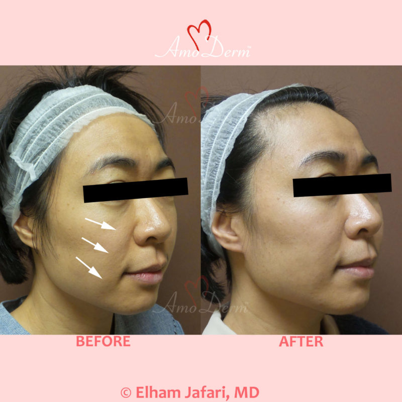 Liquid Facelift with PDO Thread (thread lift) in mid face (cheeks and nasolabial folds, laugh lines)