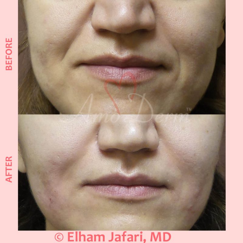 Treatment of nasolabial folds as part of non-surgical facelift