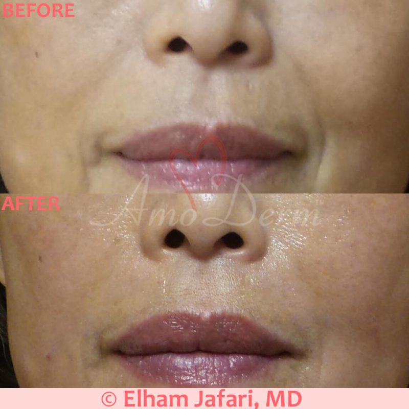 Treatment of nasolabial folds as part of non-surgical facelift