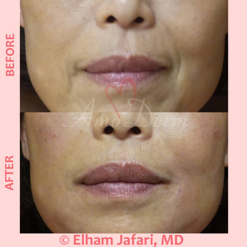 Treatment of nasolabial folds and marionette lines