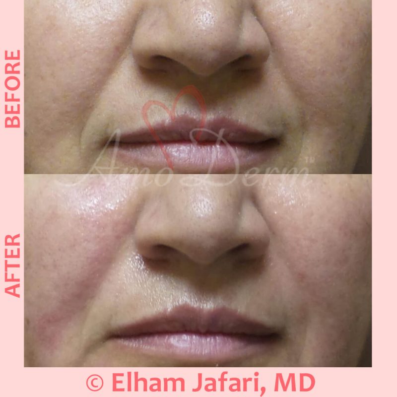 Treatment of nasolabial folds as part of non-surgical facelift