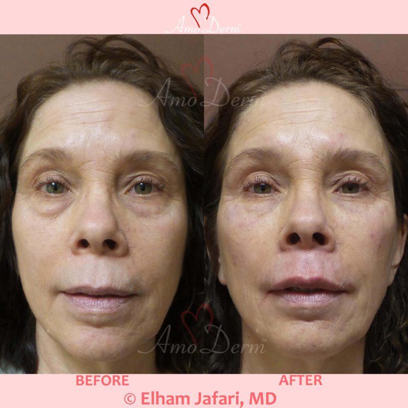 Liquid Facelift with Botox &amp; filler injection in jawlines, under the eyes &amp; cheeks