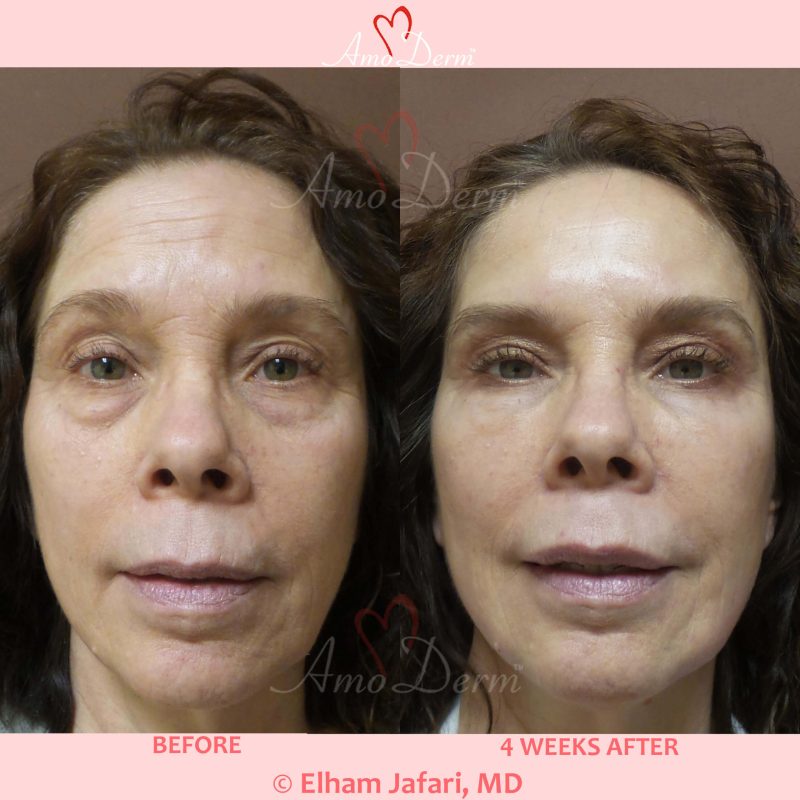 Liquid Facelift with Botox &amp; filler injection in jawlines, under the eyes &amp; cheeks