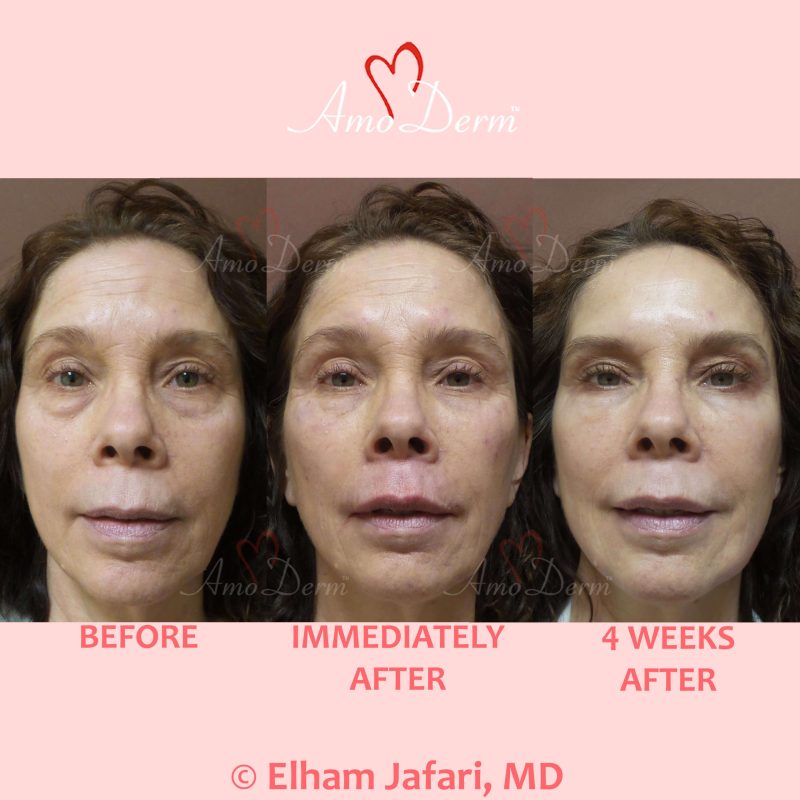 Liquid Facelift with Botox &amp; filler injection in jawlines, under the eyes &amp; cheeks