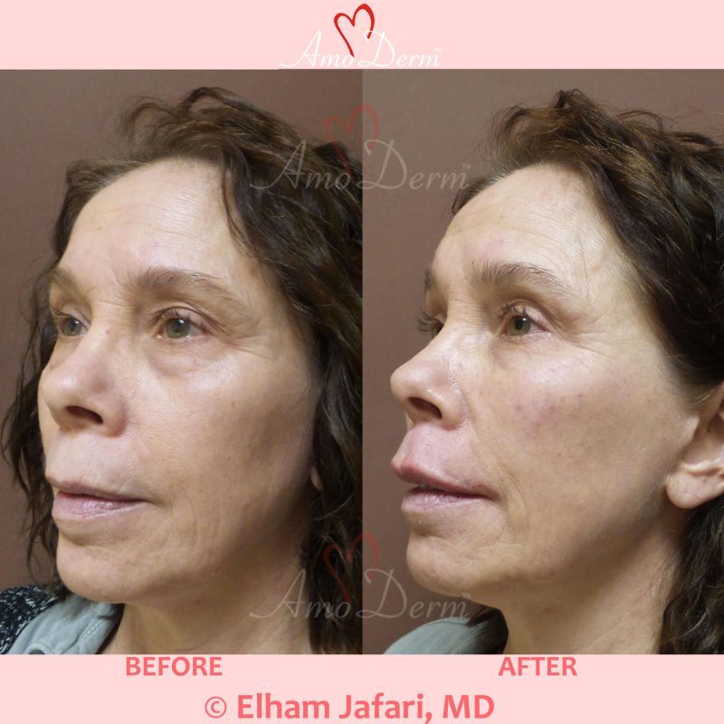 Liquid Facelift with Botox &amp; filler injection in jawlines, under the eyes &amp; cheeks