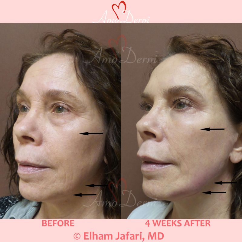 Liquid Facelift with Botox &amp; filler injection in jawlines, under the eyes &amp; cheeks