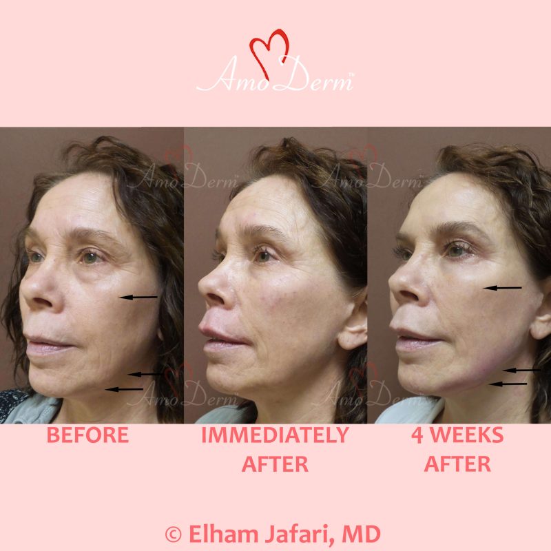 Liquid Facelift with Botox &amp; filler injection in jawlines, under the eyes &amp; cheeks