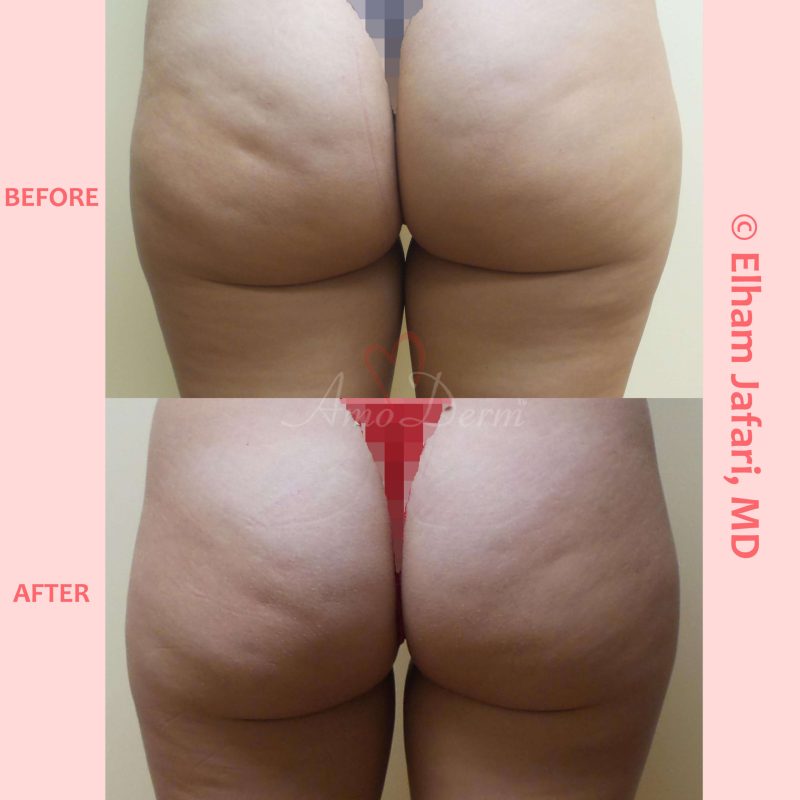 Skin tightening and cellulite treatment with Venus Freeze (radiofrequency)