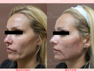 Liquid Facelift with PDO Thread in mid and lower face