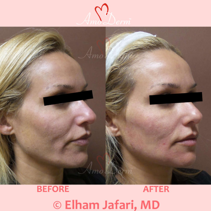 Liquid Facelift with PDO Thread in mid and lower face