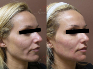 Liquid Facelift with PDO Thread in mid and lower face