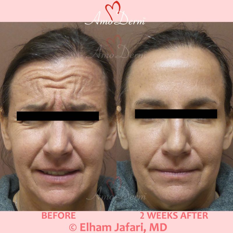Botox injection for treatment of lines and wrinkles in forehead