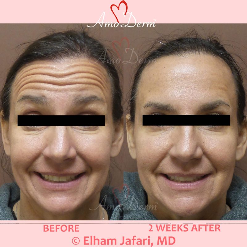 Botox injection for treatment of lines and wrinkles in forehead