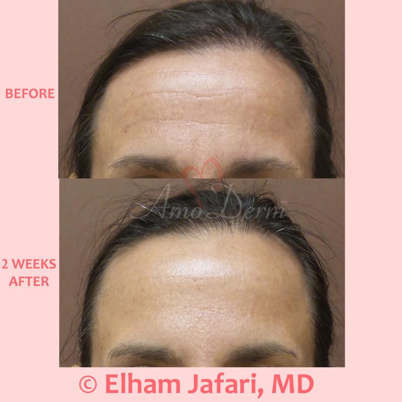 Botox injection for treatment of lines and wrinkles in forehead Botox injection for treatment of lines and wrinkles in forehead