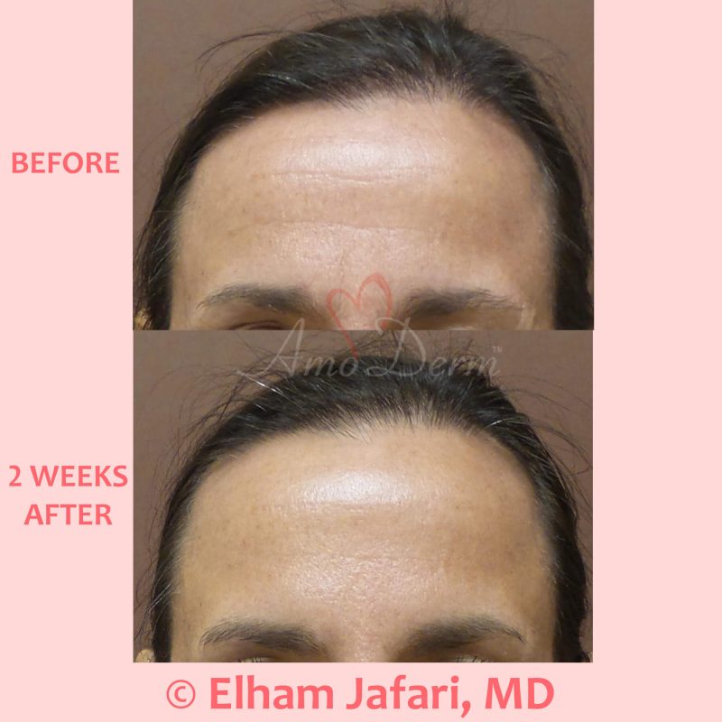 Botox injection for treatment of lines and wrinkles in forehead Botox injection for treatment of lines and wrinkles in forehead