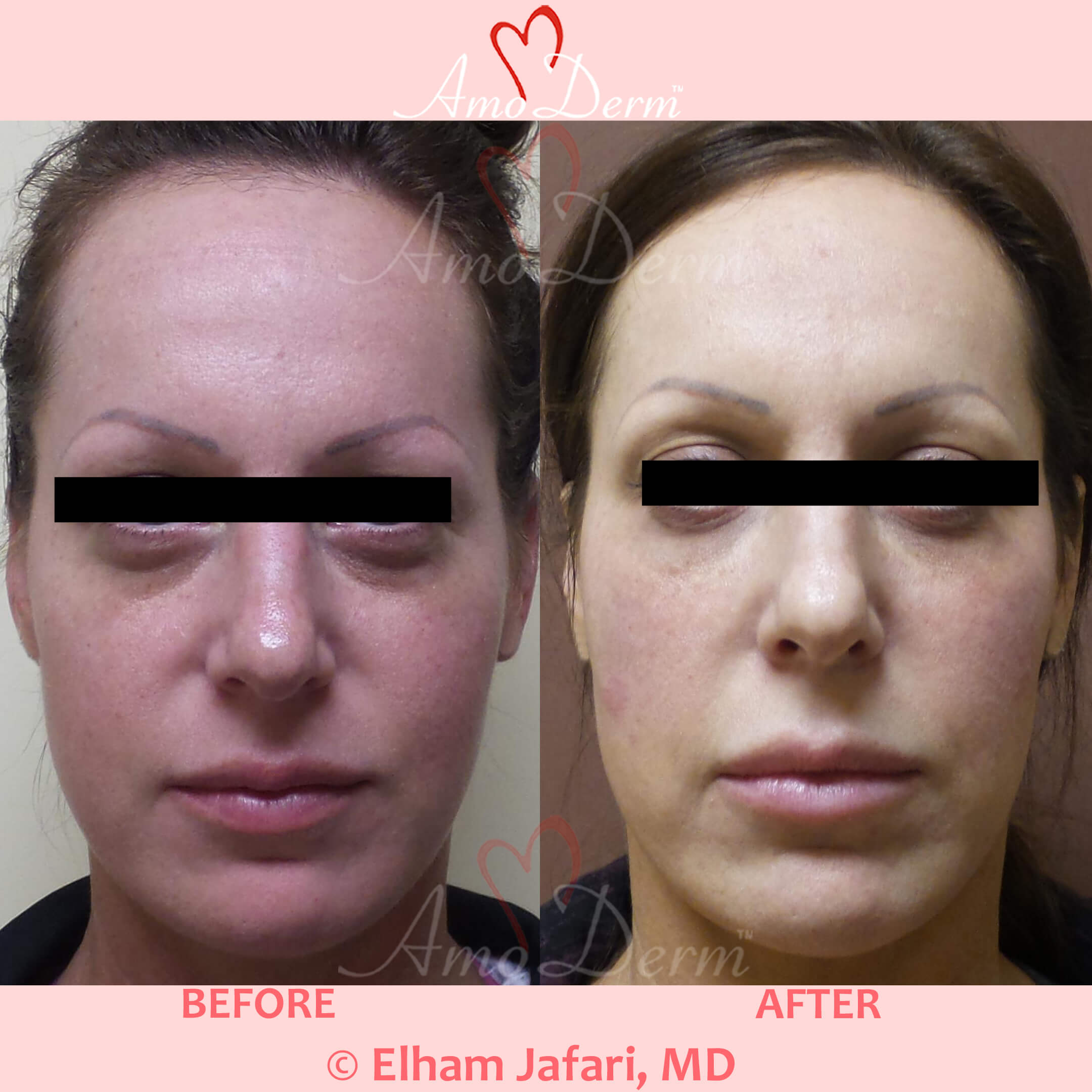 4D Under Eye Lift to treat dark circles under eyes & contour cheeks