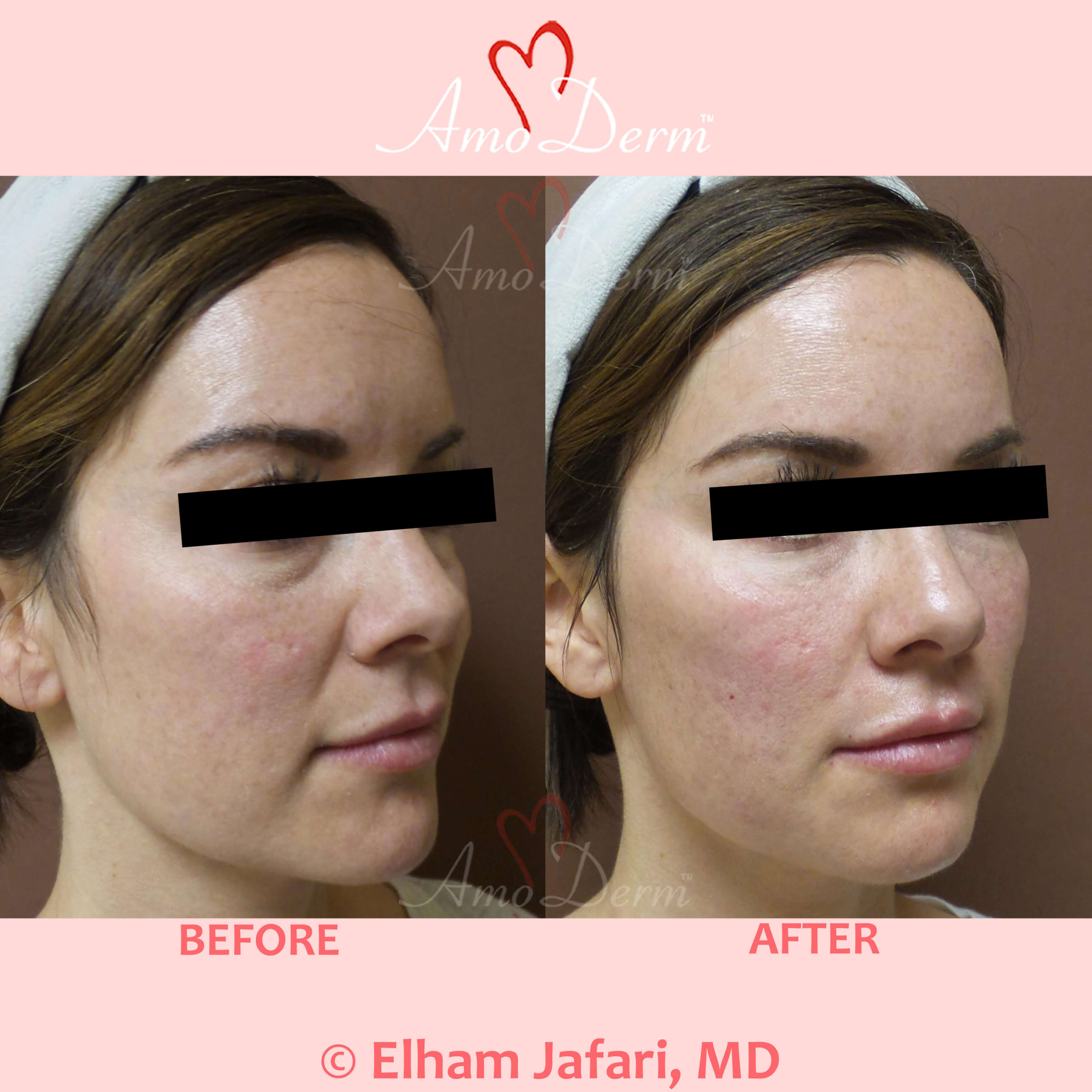 4D Under Eye Lift to treat dark circles under eyes & contour cheeks