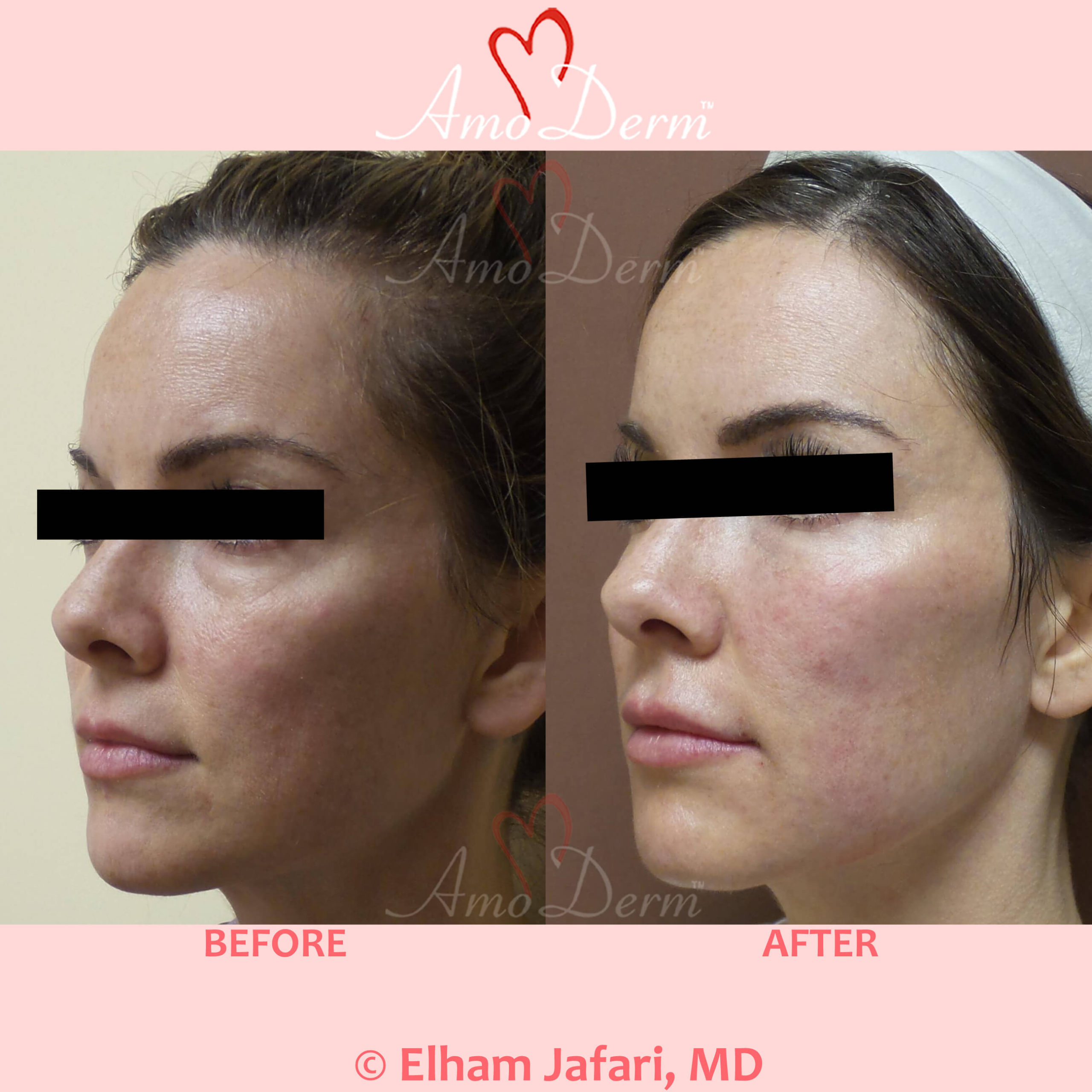 4D Under Eye Lift to treat dark circles under eyes & contour cheeks