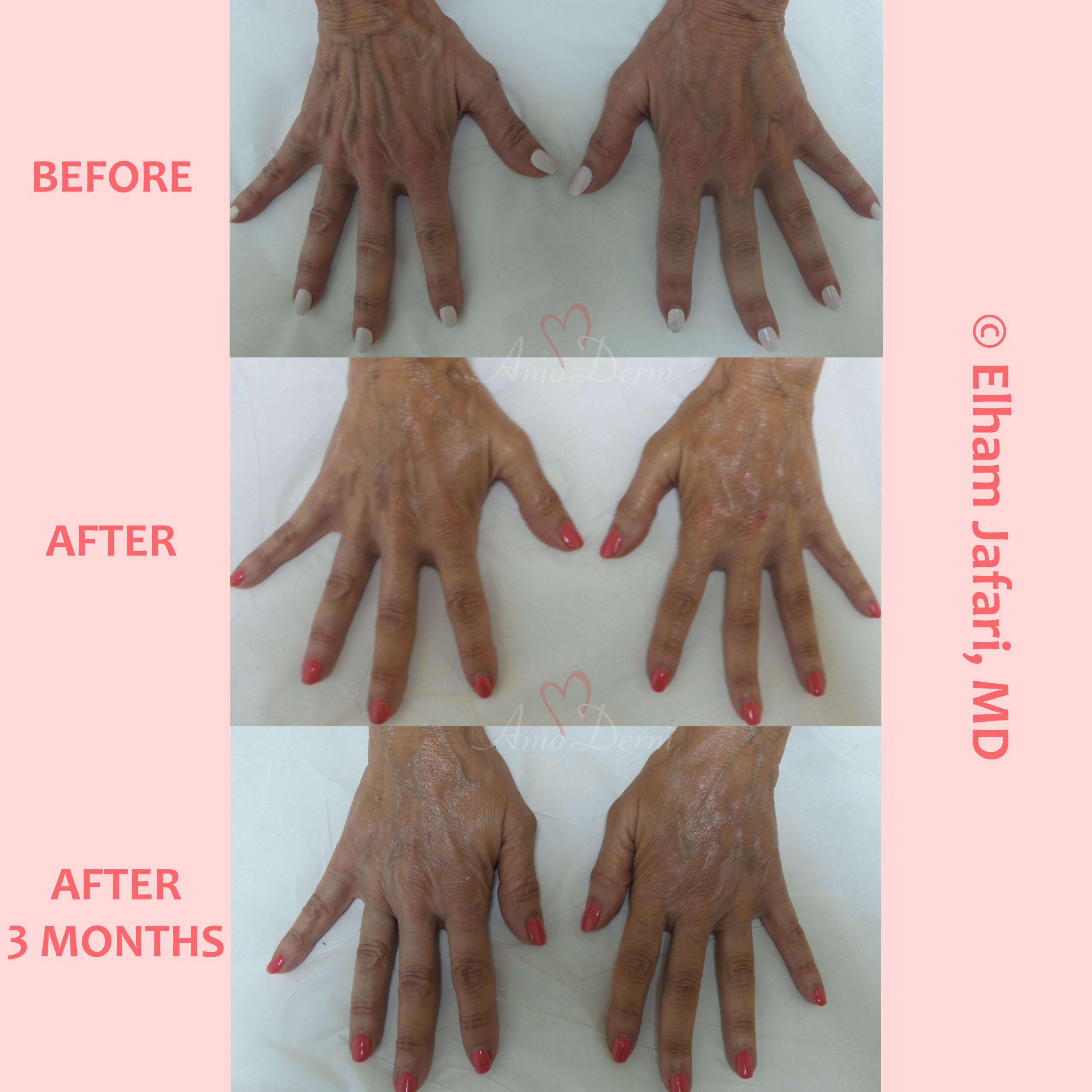Hand rejuvenation with dermal filler injection