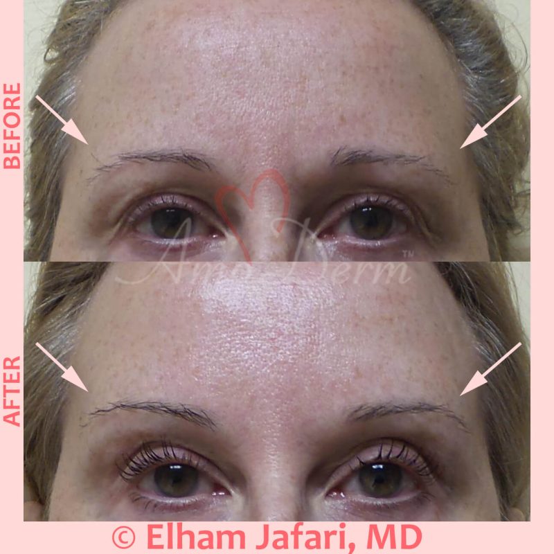 Non-surgical eyebrow lift with dermal filler Non-surgical eyebrow lift with dermal filler