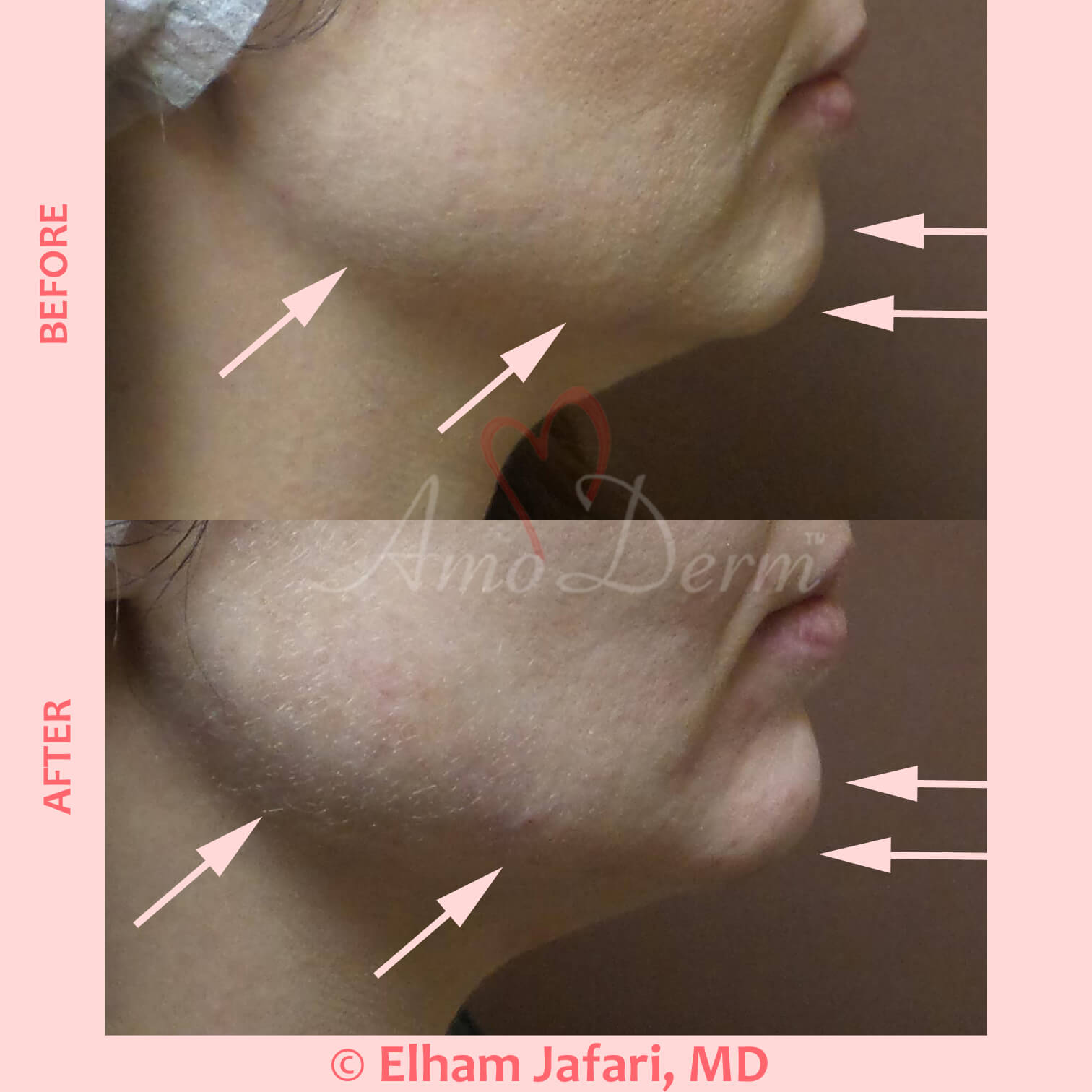 Bellafill (Artefill), the Beauty that Lasts Collagen Injection in OC