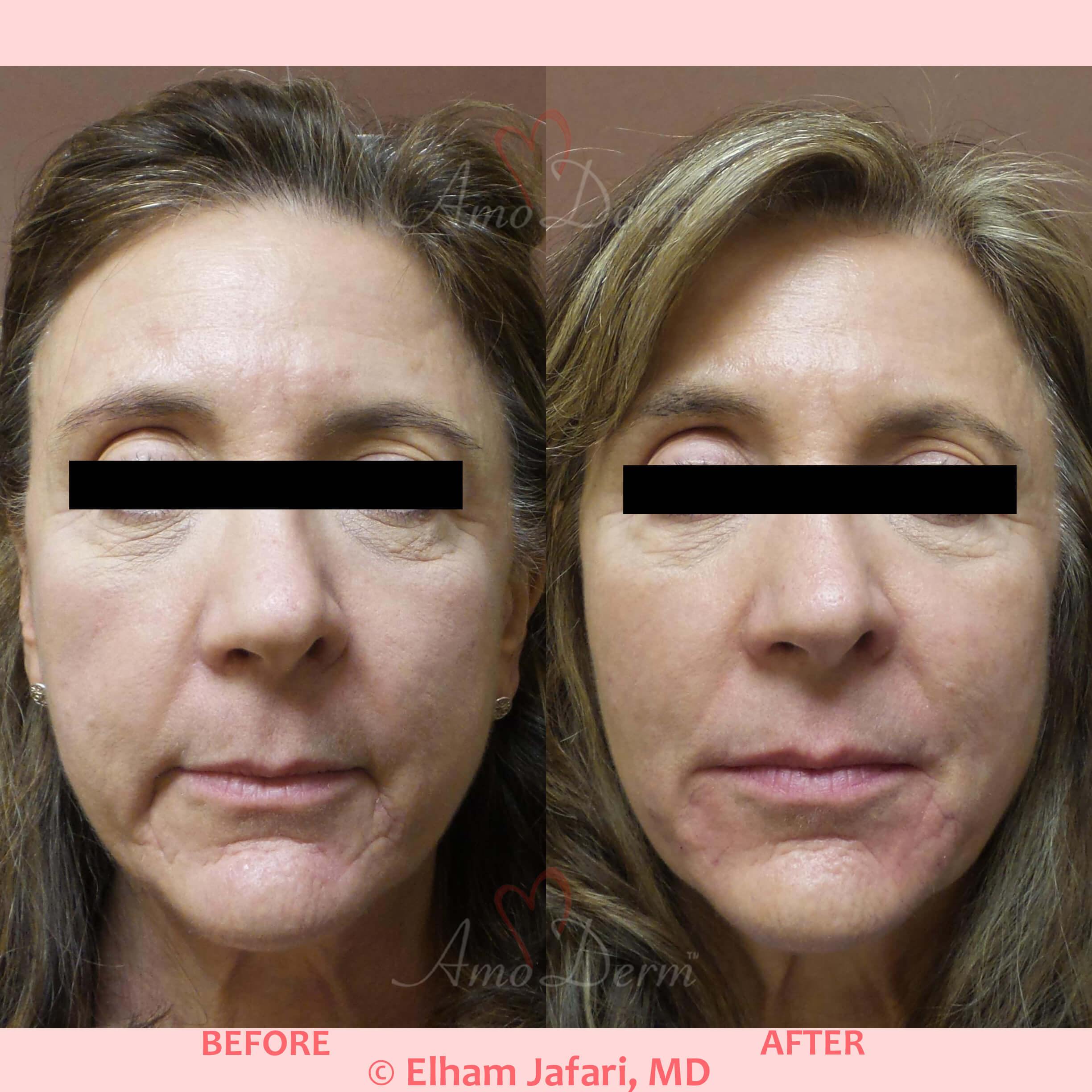 List 98+ Pictures Lines Before And After Photos Full HD, 2k, 4k