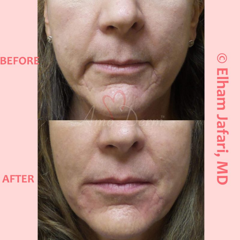 Treatment of nasolabial folds as part of non-surgical facelift