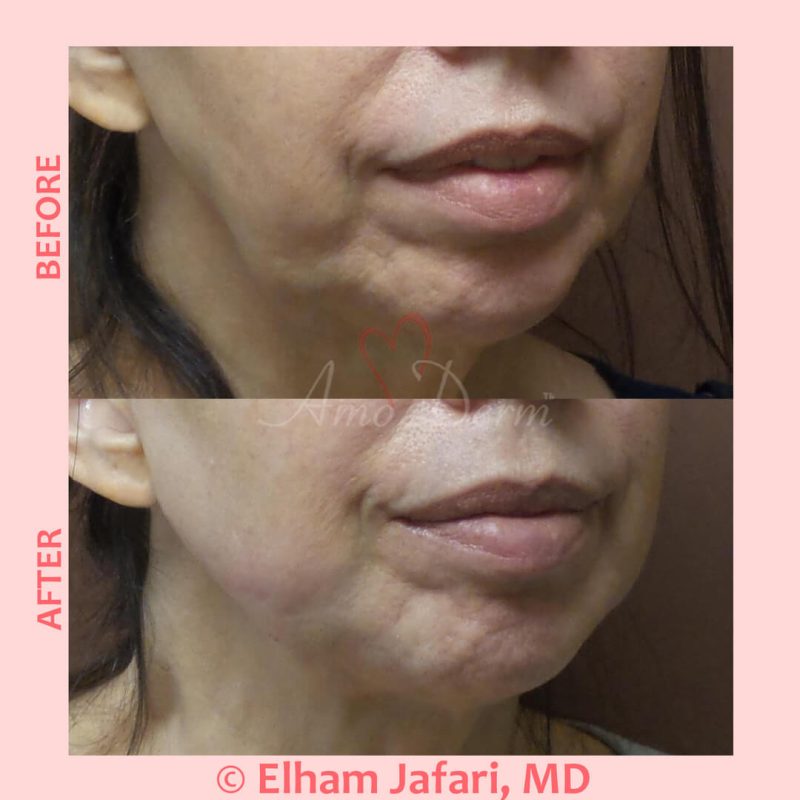 Filler for jawline sculpting and contouring to create a chisled jawline as well as lip augmentation