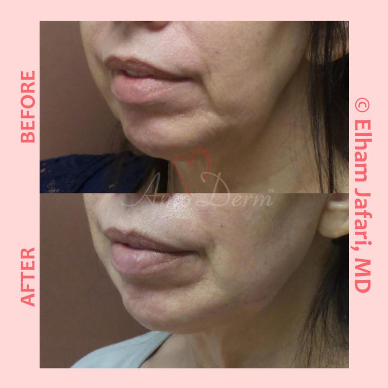 Filler for jawline sculpting and contouring to create a chisled jawline as well as lip augmentation