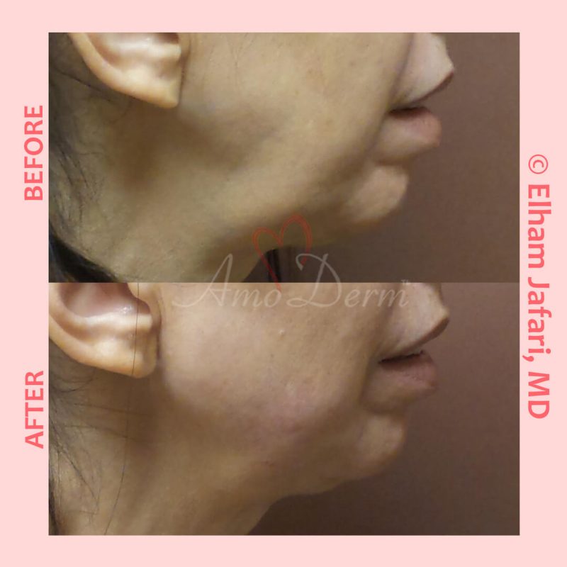 Filler for jawline sculpting and contouring to create a chisled jawline as well as lip augmentation